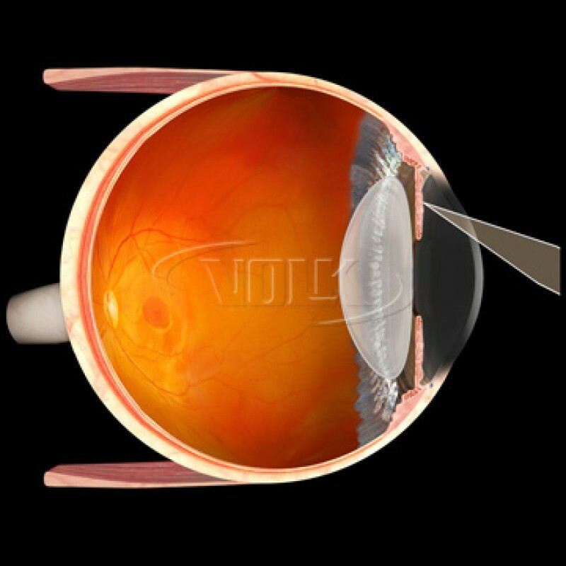 Volk Blumenthal Iridotomy Lens